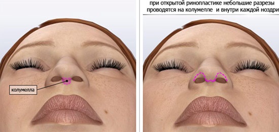 Plastic surgery on the nose. Types, prices: correction of the septum, reduction of the nose, remove the hump, reshape, contour rhinoplasty