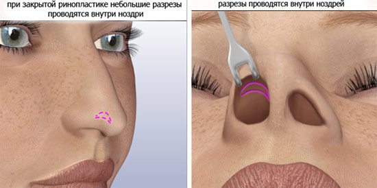 Plastic surgery on the nose. Types, prices: correction of the septum, reduction of the nose, remove the hump, reshape, contour rhinoplasty