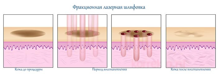 Acne on the chin in women on the face. Causes of appearance after 30 years, during pregnancy. Which organ is out of order, home remedies