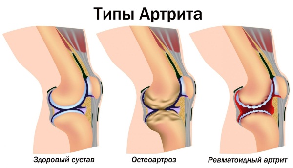 Warming ointments for muscles and joints: principle of action, indications and contraindications, application features, inexpensive drugs