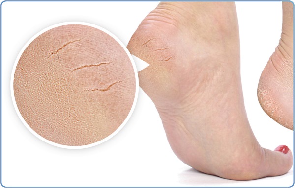 Causes and treatment of cracked heels at home. Preparations, ointments, hydrogen peroxide, aspirin, folk remedies