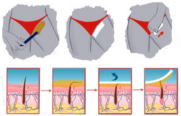 Wax depilation or sugaring? What is better in the deep bikini area, legs, armpits