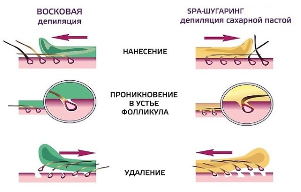 Wax depilation or sugaring? What is better in the deep bikini area, legs, armpits