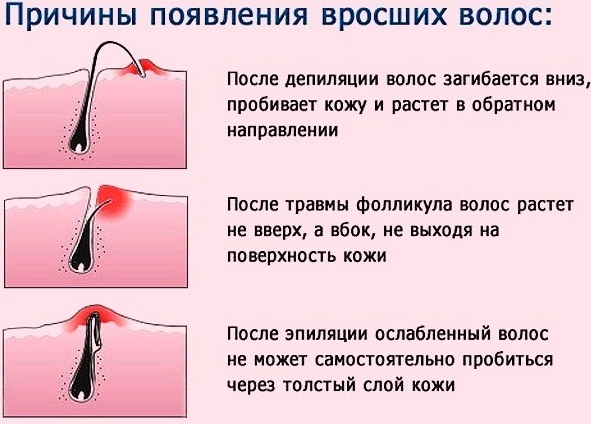 Women's depilation in intimate places, bikini area. How to do, which cream, product, epilator is better