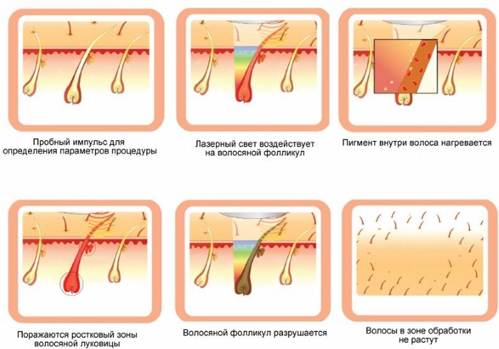 Women's depilation in intimate places, bikini area. How to do, which cream, product, epilator is better