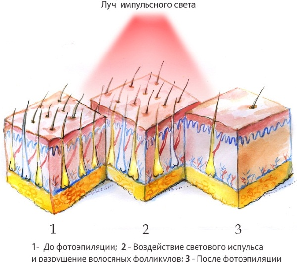 Women's depilation in intimate places, bikini area. How to do, which cream, product, epilator is better