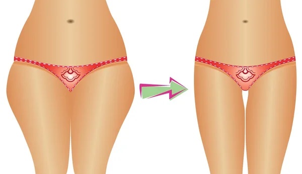 How to remove the ears on the thighs in a week: exercises, liposuction, cupping massage, wraps