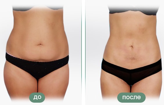 Laser liposuction. What is it, how is it done for the abdomen, chin, face, thighs, cheeks, legs, buttocks, arms, widow's hump. Before and after photos, reviews, price of the procedure