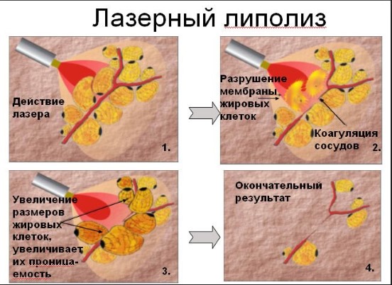 Laser liposuction. What is it, how is it done for the abdomen, chin, face, thighs, cheeks, legs, buttocks, arms, widow's hump. Before and after photos, reviews, price of the procedure