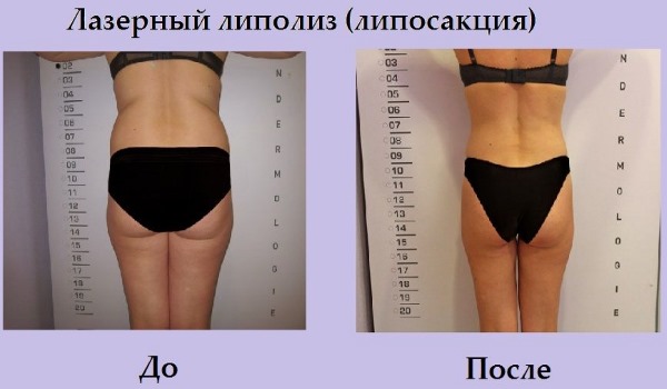 Laser liposuction. What is it, how is it done for the abdomen, chin, face, thighs, cheeks, legs, buttocks, arms, widow's hump. Before and after photos, reviews, price of the procedure