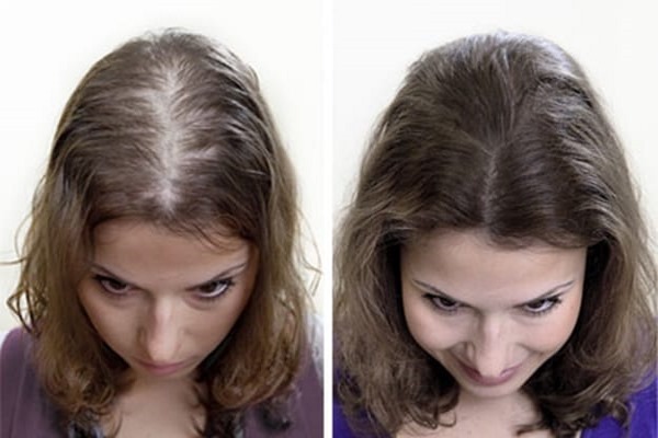 Plasma therapy for hair and scalp: what is it, results, indications and contraindications