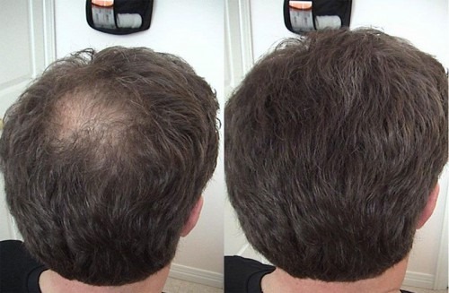 Plasma therapy for hair and scalp: what is it, results, indications and contraindications