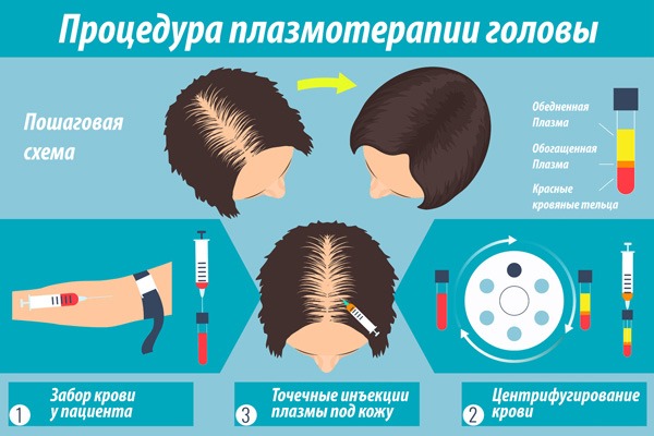 Plasma therapy for hair and scalp: what is it, results, indications and contraindications