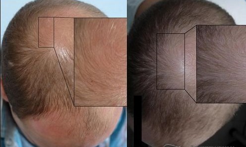 Plasma therapy for hair and scalp: what is it, results, indications and contraindications