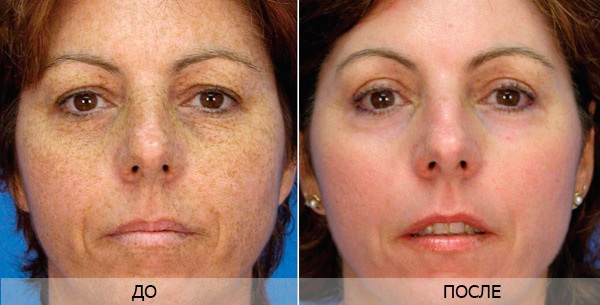 Face resurfacing. Photos before and after laser, CO2, diamond, fractional, radiofrequency. Pros and cons, stages, rehabilitation