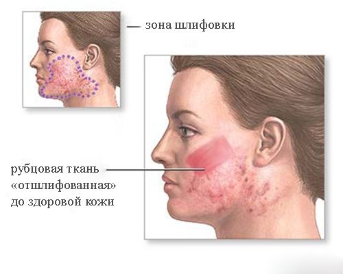 Face resurfacing. Photos before and after laser, CO2, diamond, fractional, radiofrequency. Pros and cons, stages, rehabilitation