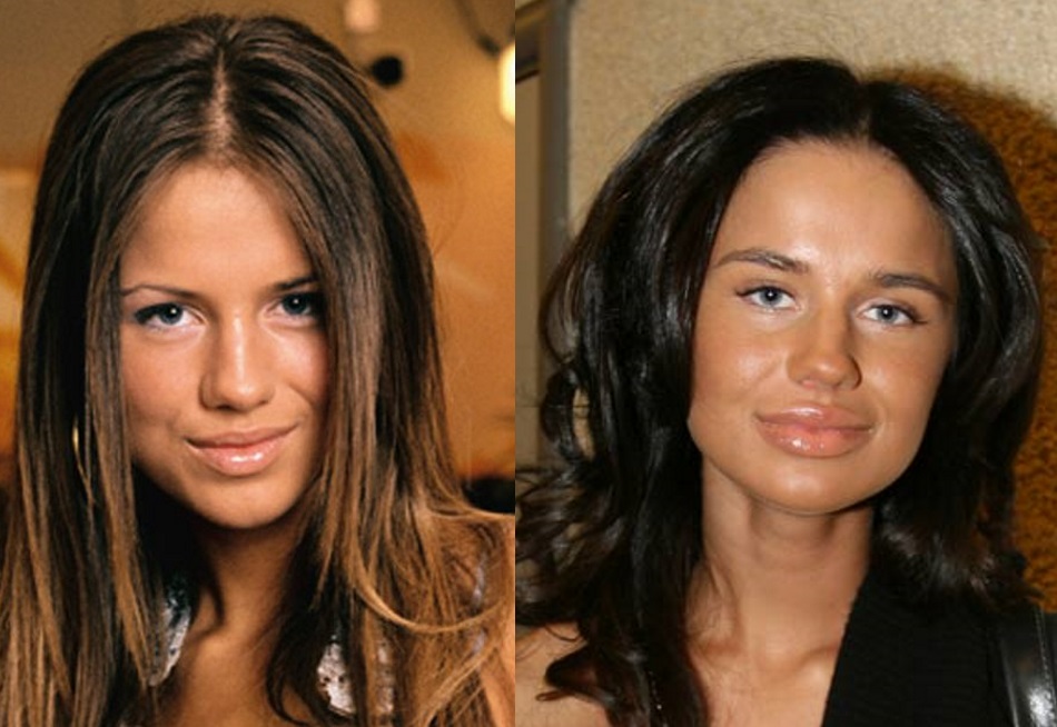 Stars before and after plastic surgery. Photos Russian, Hollywood, Korean, unsuccessful, victims, Instagram, at home 2