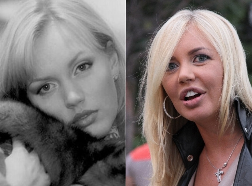 Stars before and after plastic surgery. Photos Russian, Hollywood, Korean, unsuccessful, victims, Instagram, at home 2