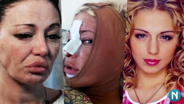 Stars before and after plastic surgery. Photos Russian, Hollywood, Korean, unsuccessful, victims, Instagram, at home 2