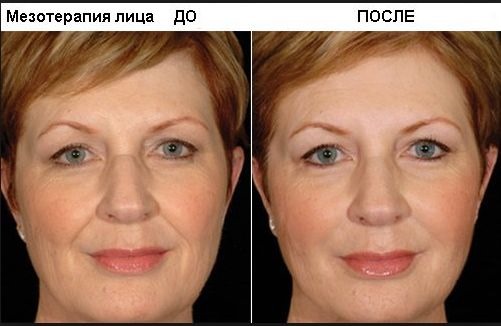 Hyaluronic acid in cosmetology. Injections, tablets, face creams. Benefits, before and after photos. Drug reviews