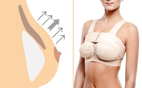 Breast lift without implants. Procedures and methods for elasticizing breasts in cosmetology