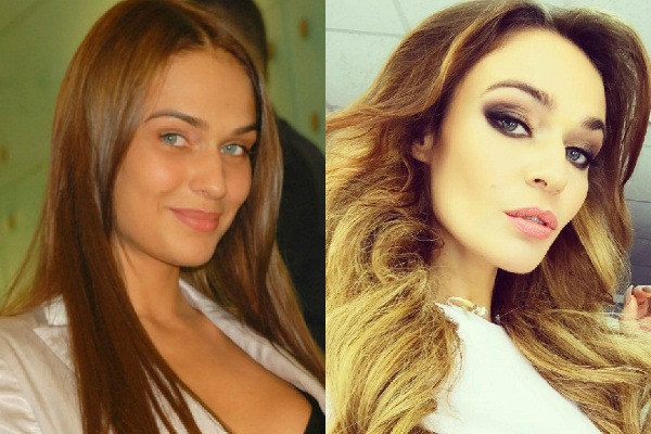 Alena Vodonaeva before and after plastics. Photo, shape parameters, height, weight, hair color. Nose reduction surgery that did to the teeth