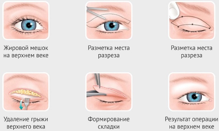 Blepharoplasty in Moscow. Prices in 2020, rating of clinics, how to choose a surgeon, promotions, discounts