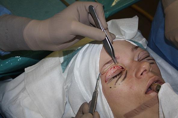 Blepharoplasty in Moscow. Prices in 2020, rating of clinics, how to choose a surgeon, promotions, discounts