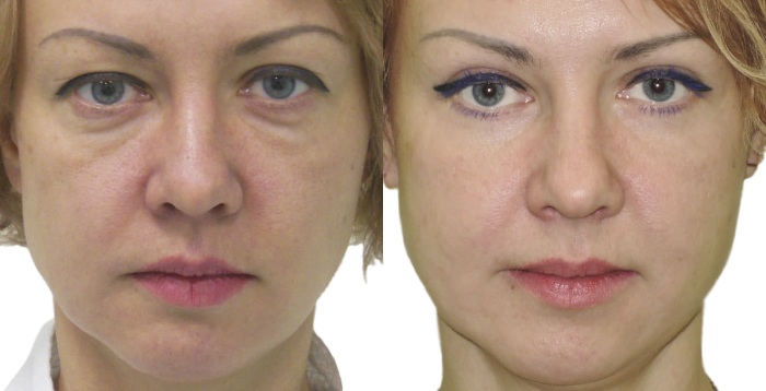 Blepharoplasty in Moscow. Prices in 2020, rating of clinics, how to choose a surgeon, promotions, discounts