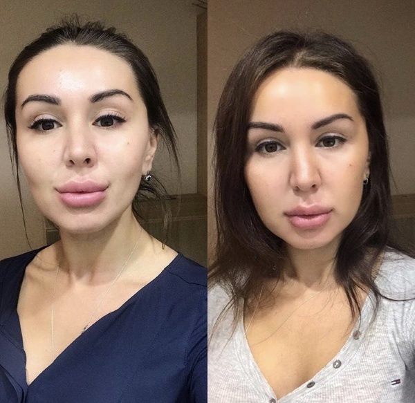 How to remove lumps of Bisha. How to clean at home, massage, exercise, diet, surgery. Before and after photos