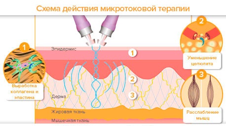 Lymphatic drainage massage of legs, thighs, abdomen with lymphedema, varicose veins, edema, varicose veins, pregnancy. Technique how to do it yourself