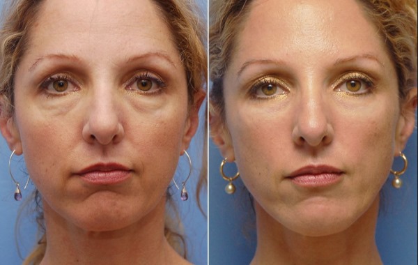 Restylane filler, biorevitalization. Reviews. Vital, Perline, Skinbooster for lip augmentation, under the eyes. Price, efficiency, photo