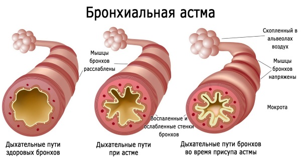 Exercises with dumbbells for the back. Training program for tightening muscles, with hernia of the spine, scoliosis, osteochondrosis