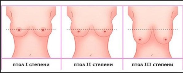 Breast enlargement. Cost in Moscow, St. Petersburg. Types of implants, prices