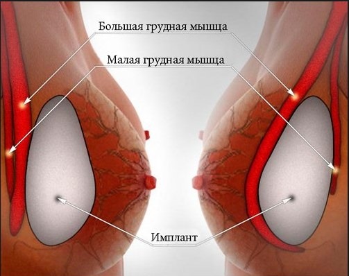 Breast enlargement. Cost in Moscow, St. Petersburg. Types of implants, prices