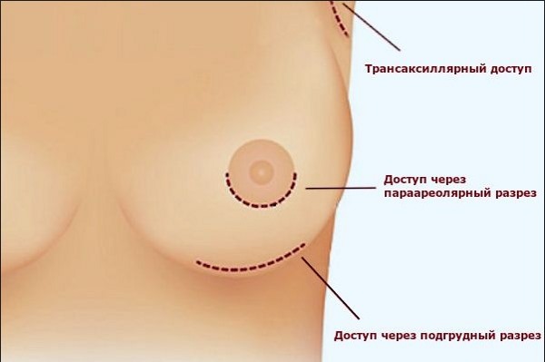 Breast enlargement. Cost in Moscow, St. Petersburg. Types of implants, prices