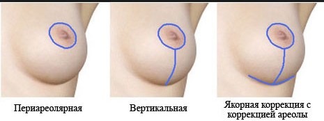 Breast enlargement. Cost in Moscow, St. Petersburg. Types of implants, prices