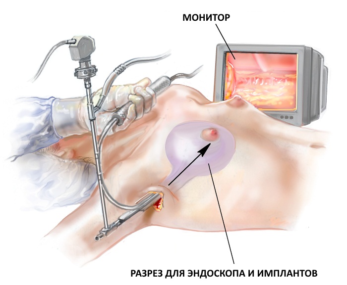 Breast enlargement. Cost in Moscow, St. Petersburg. Types of implants, prices