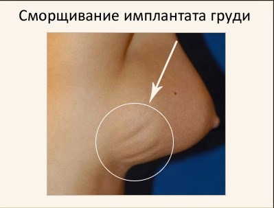 Breast enlargement. Cost in Moscow, St. Petersburg. Types of implants, prices