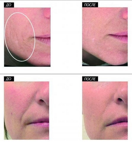 Vacuum hydropeeling Hydra Feshl hydrafacial. What is this procedure, description, devices, price