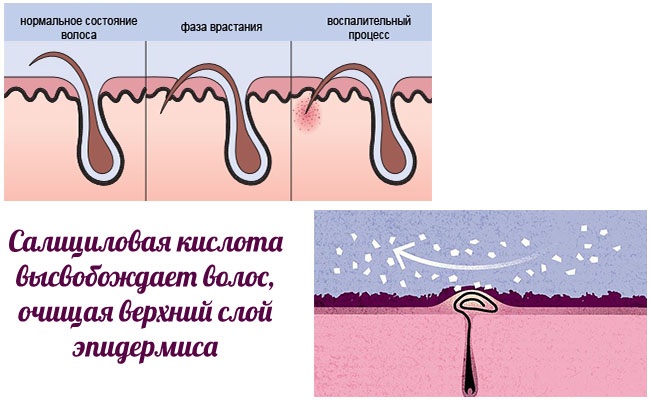 Peli incarniti sulle gambe, nella zona bikini, peli pubici dopo lo shugaring, epilazione. Mezzi di trattamento: unguenti, lozioni, creme, scrub, badyaga, Bepanten, Levomekol