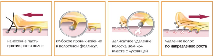 Peli incarniti sulle gambe, nella zona bikini, peli pubici dopo lo shugaring, epilazione. Mezzi di trattamento: unguenti, lozioni, creme, scrub, badyaga, Bepanten, Levomekol