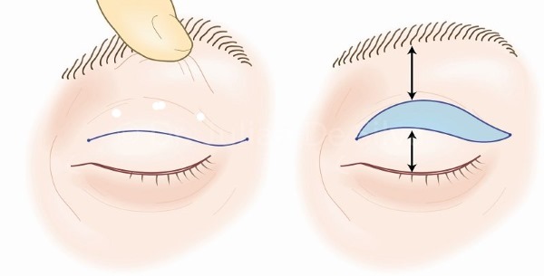 Blepharoplasty. Reviews of the operated. Pros and cons of plastic surgery, complications, rehabilitation. Laser, transconjunctival, circular, injection