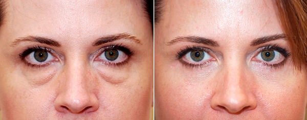 Blepharoplasty. Reviews of the operated. Pros and cons of plastic surgery, complications, rehabilitation. Laser, transconjunctival, circular, injection