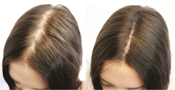 Darsonval for hair. Reviews, instructions for using the combs for growth, from loss. Price