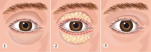 Laser blepharoplasty.Reviews of the operated lower, upper eyelids, how they do it. Prices