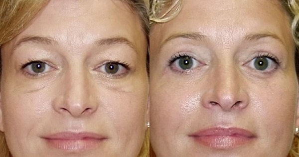 Laser blepharoplasty. Reviews of the operated lower, upper eyelids, how they do it. Prices