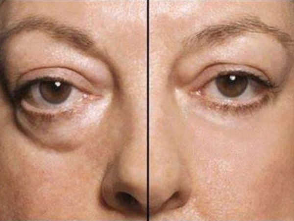 Laser blepharoplasty. Reviews of the operated lower, upper eyelids, how they do it. Prices