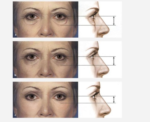 Laser blepharoplasty. Reviews of the operated lower, upper eyelids, how they do it. Prices