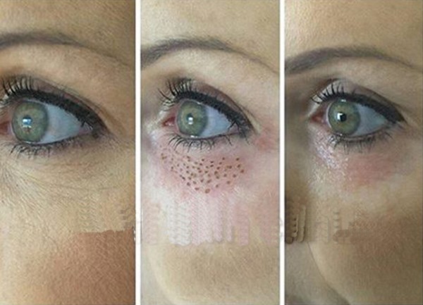 Laser blepharoplasty. Reviews of the operated lower, upper eyelids, how they do it. Prices